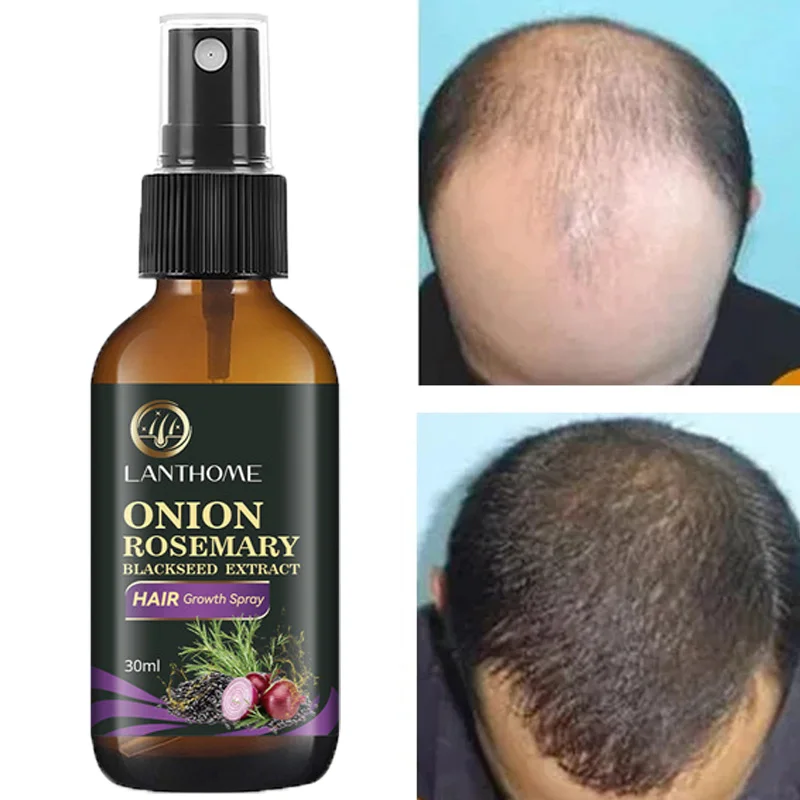 Fast Hair Growth Spray Serum Anti Hair Loss Treatment Essence Oil Treat Thinning Scalp Dry Damaged Beard Skin Care 30ML