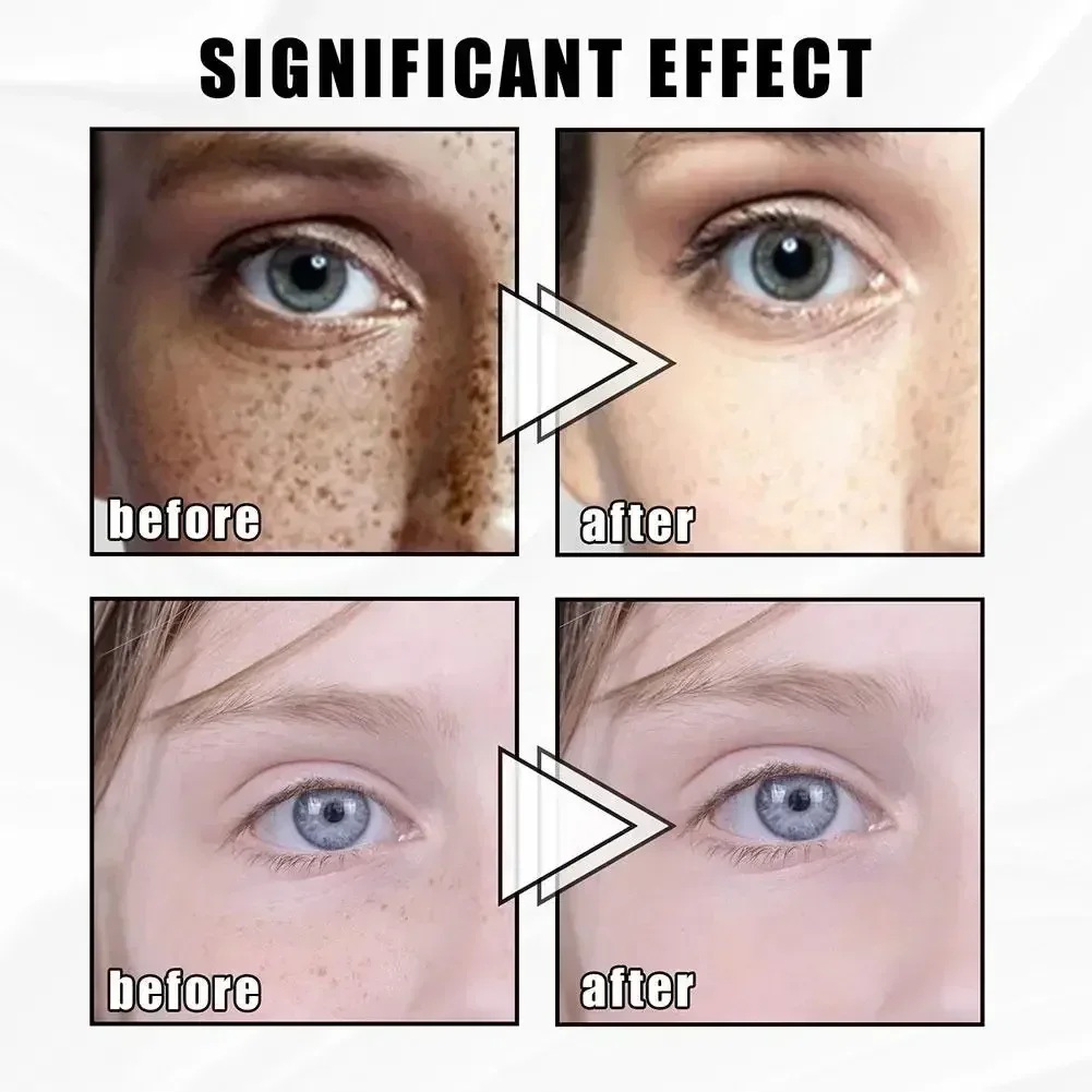 Отбеливающий крем для удаления веснушек осветляющий тон удаление темных пятен