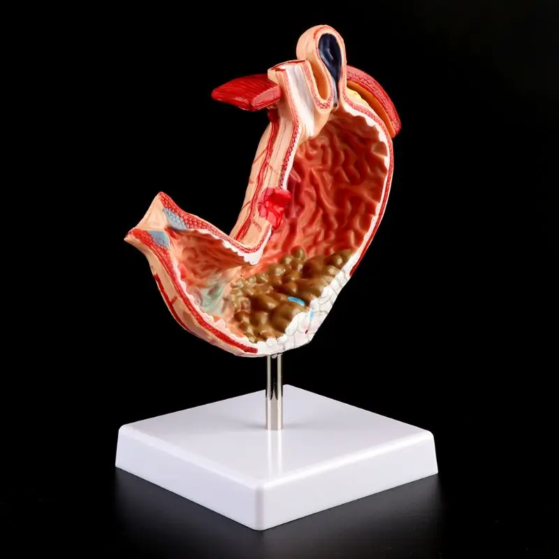 

Human Anatomical Anatomy Stomach Medical Model Gastric Pathology Gastritis Ulcer Medical Teaching Learning Tool