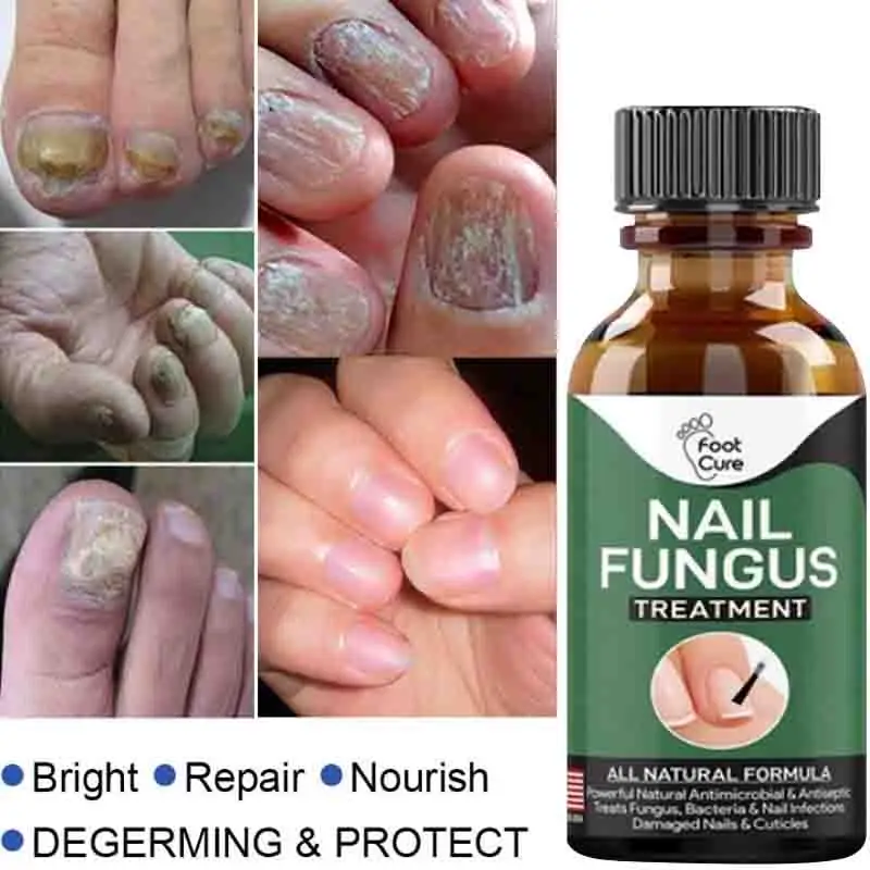 

Fungal Nail Treatment Serum Nail Finger Toe Repair Anti Fungal Nail Treatment Essence Onychomycosis Removal Essence Foot Care
