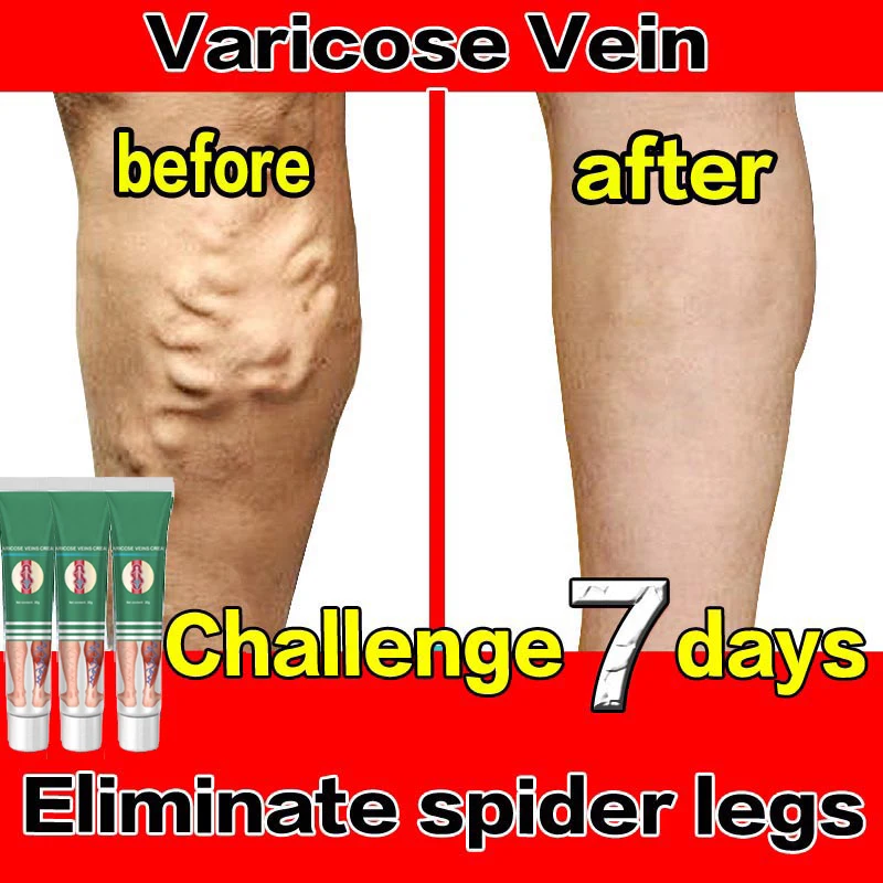 

ointment for varicose veins Effective varicose vein relief cream to relieve vasculitis phlebitis spider pain treatment