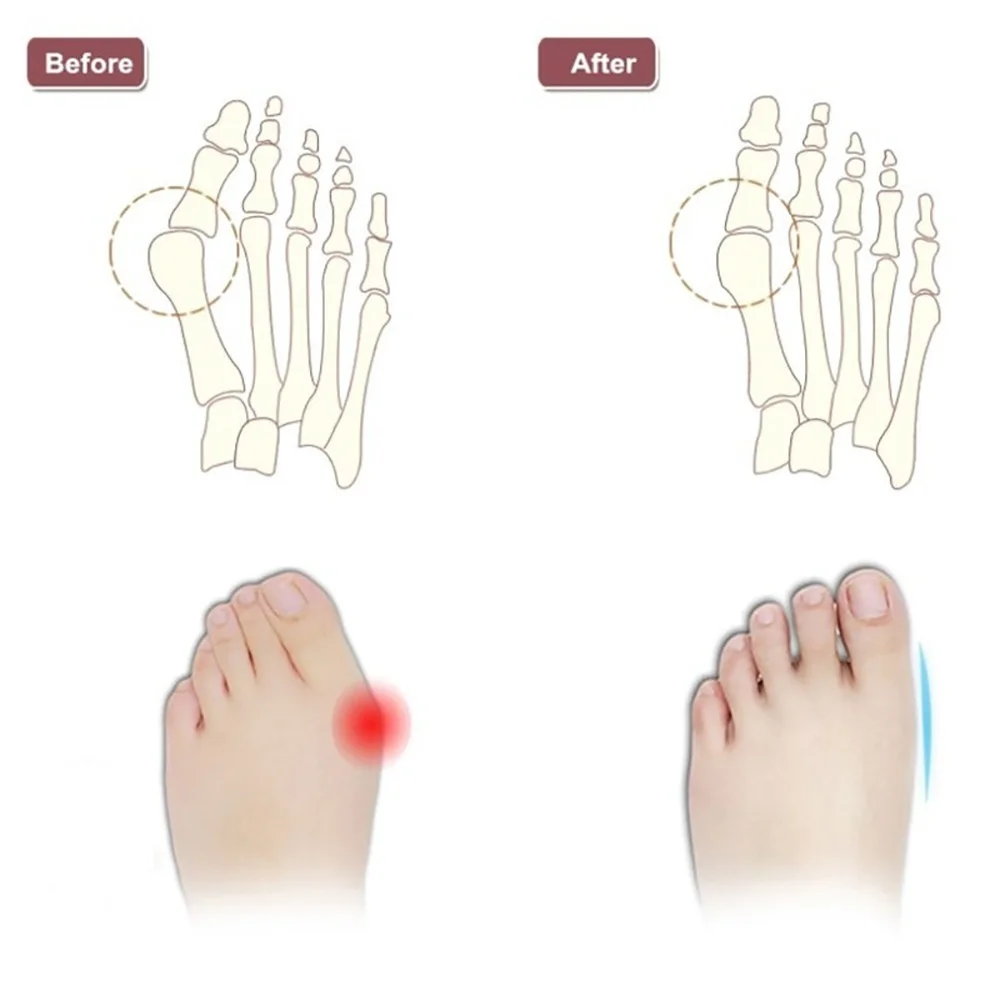 Newest 2PCS Multifunctional Hallux Valgus Foot Toes Separator Gel Toe Bunion Corrector Shield Orthopedic Braces images - 6