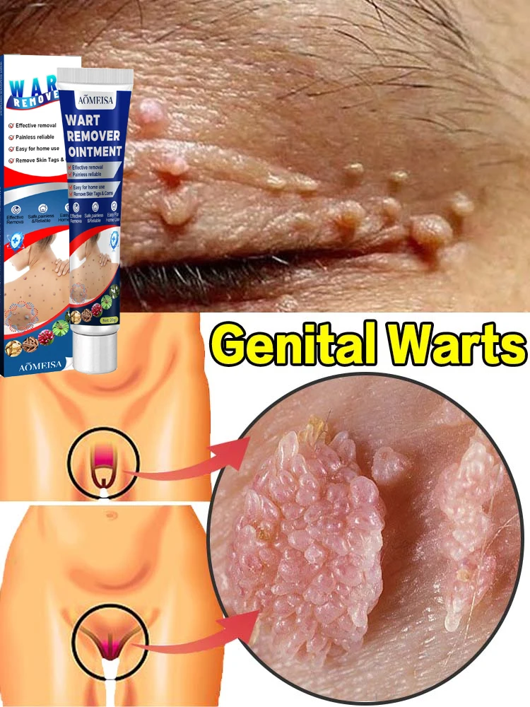 

Wart removal genital warts hpv plantar warts ommon warts flat wart skin tag wart remover ointment