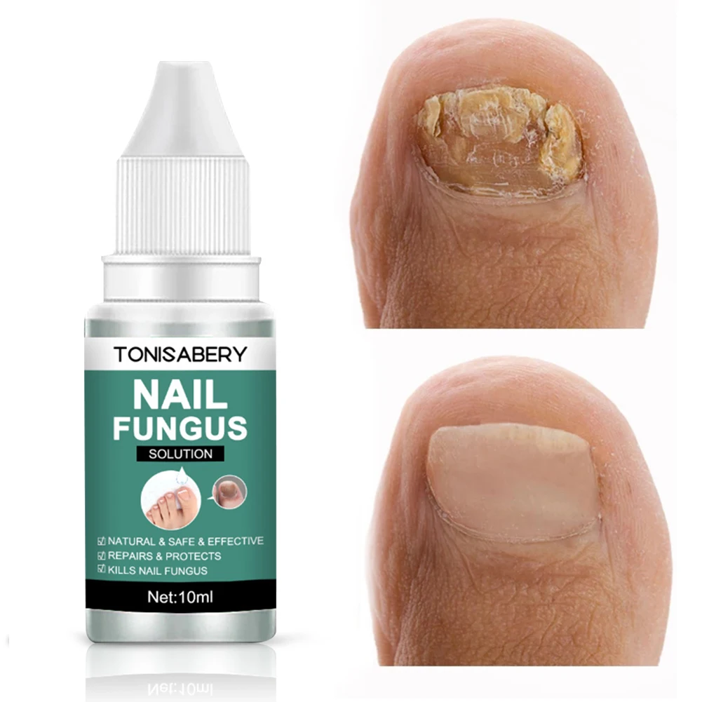 

Feet Care Nail Fungal Treatment Essence Paronychia Onychomycosis Nail Care Fungus Removal Solution Foot Nails Repairing Serum
