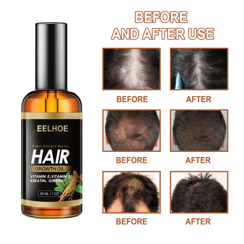 

Эфирное масло для роста волос продукты, спрей против выпадения волос, сыворотка для лечения имбиря, сухие волнистые поврежденные тонкие волосы, питают корни волос