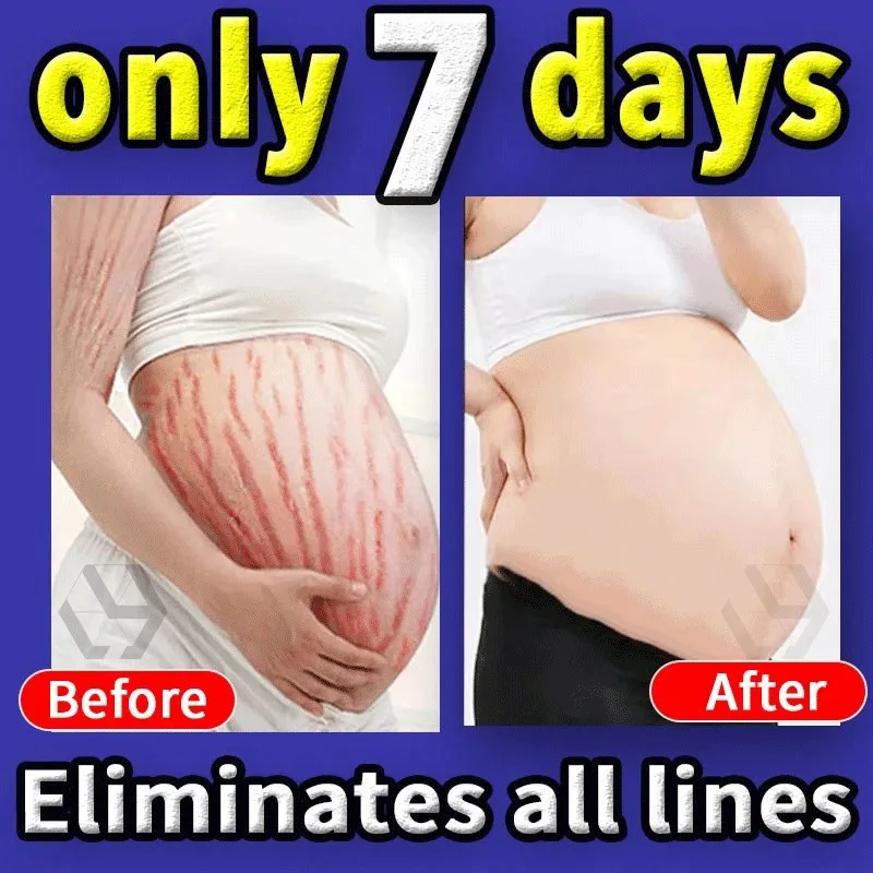 

Pregnancy Repair Cream Stretch Mark Permanent Removal Acne Scar Stretch Marks Cream Fat Striae Gravidarum Treatment Body Creams