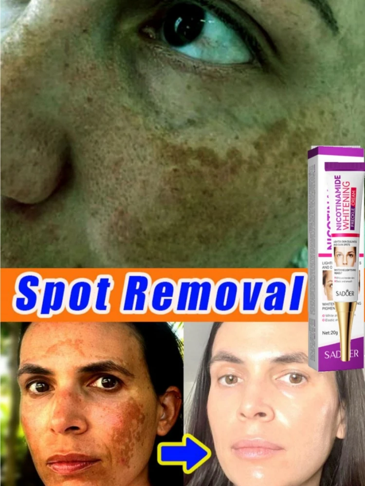 

Whitening Cream for Dark Skin Freckles Remove Dark Spot Melasma Sun Spots Pigmentation Remover Face Brightening Care Moisturizer