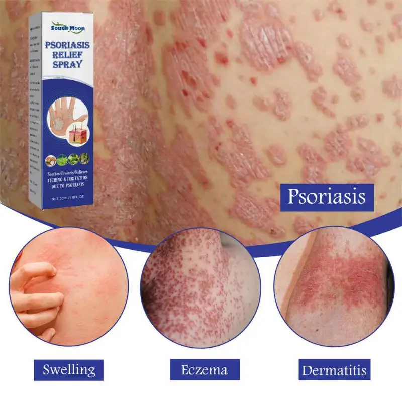 

Skin Psoriasis Spray Herb Essence Dermatitis Eczematoid Eczema Ointment Treatment Psoriasis Anti Itching Antibacterial Spray