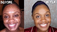 tumeric anti acne soap natural to lightening acne treatment dark spots skin glow brighter scars removal acne scars bars