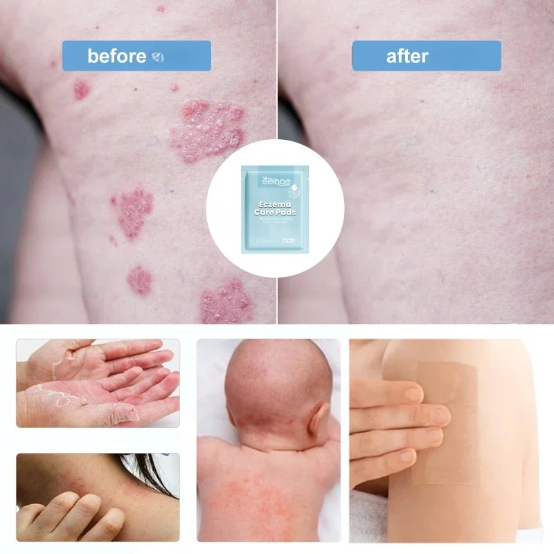 Пластырь для лечения экземы лечение псориаза тинея ингибитор дерматита грибка