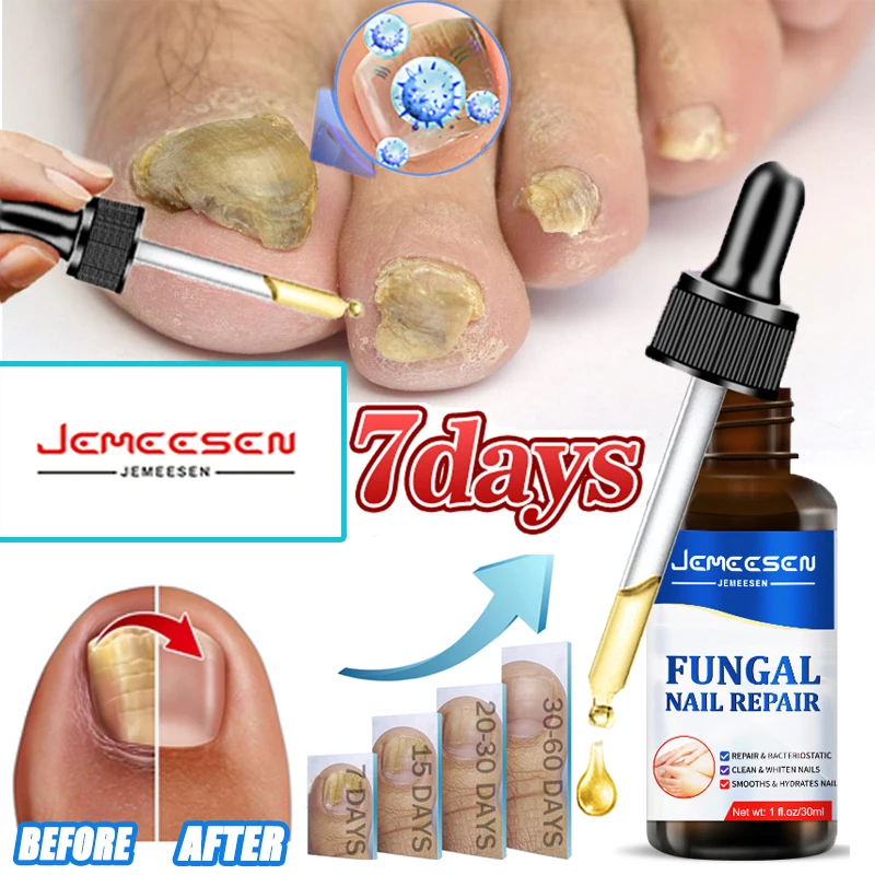 

Jemeesen Fungal Nail Repair Essence 7 Days Painless Nail Care Anti Infection Paronychia Onychomycosis Nail Fungus Removal Gel