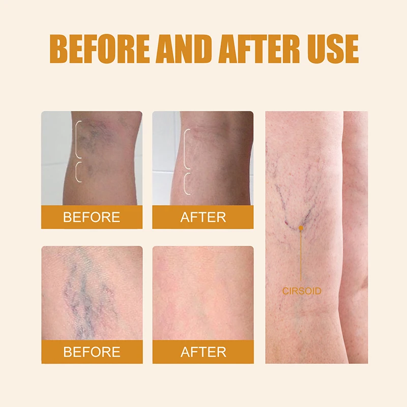 Leg Massage Body Repair Pen Lampshade Therapy For Varicose Veins Effective Relief Fatigue Improved Blood Circulation