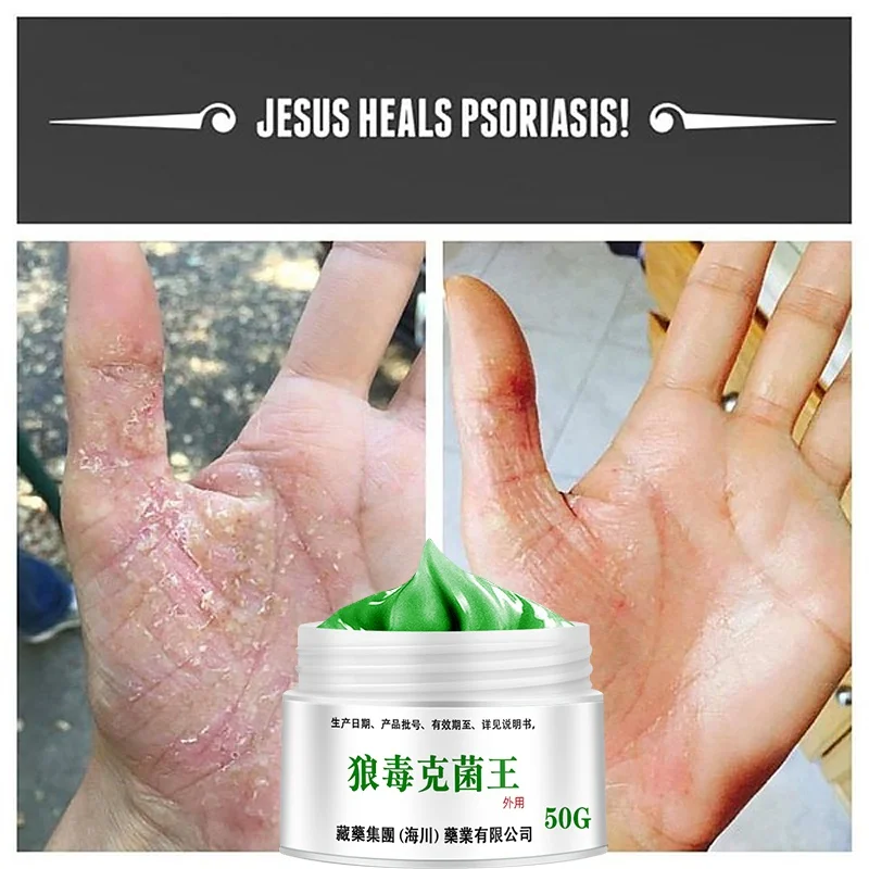 50g Psoriasis Dermatitis Eczematoid Eczema Ointment Anti-Itch Chinese Herb Medical Skin Care Cream | Feet