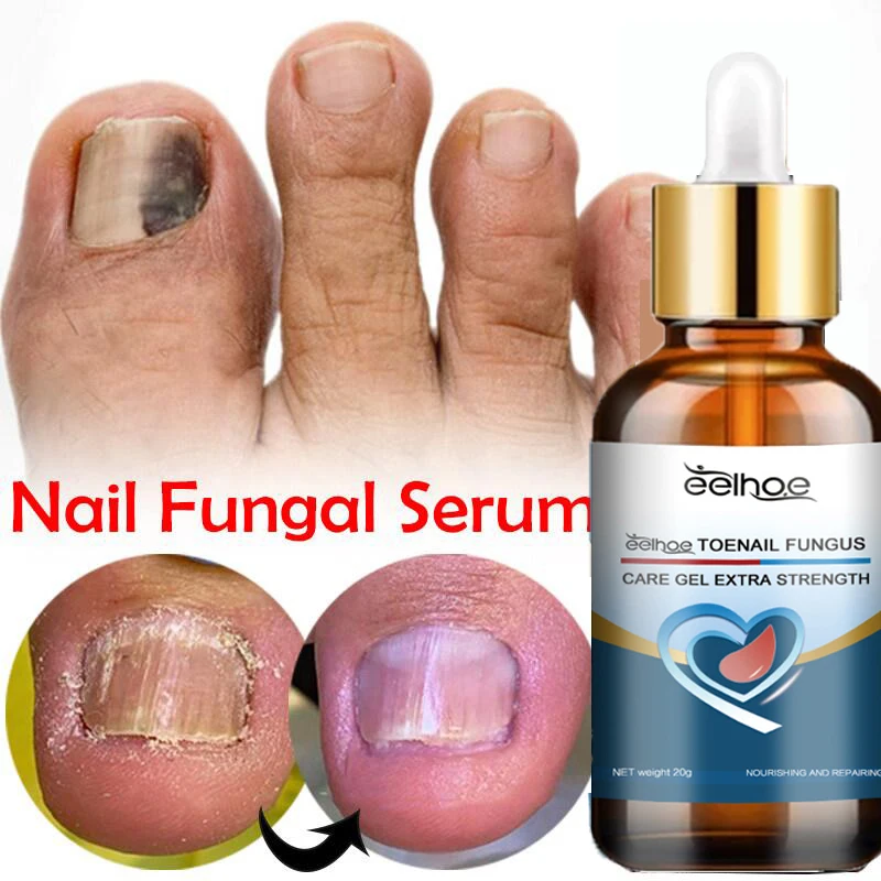 

Fungal Nails Treatment Serum Toenail Fungus Remover Essence Anti Infection Paronychia Onychomycosis Gel Repair Foot Care Health