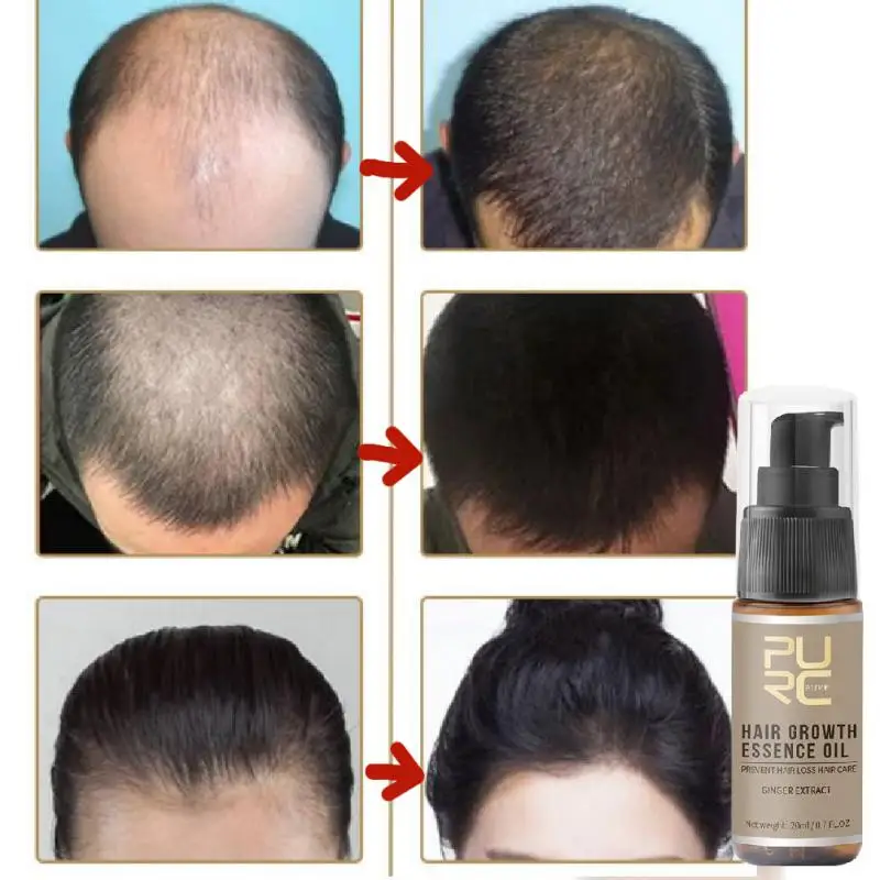 

Эссенция для роста волос, масло для лечения выпадения волос, уход за волосами, масло для быстрого роста волос, сыворотка для роста волос, уход за филировкой
