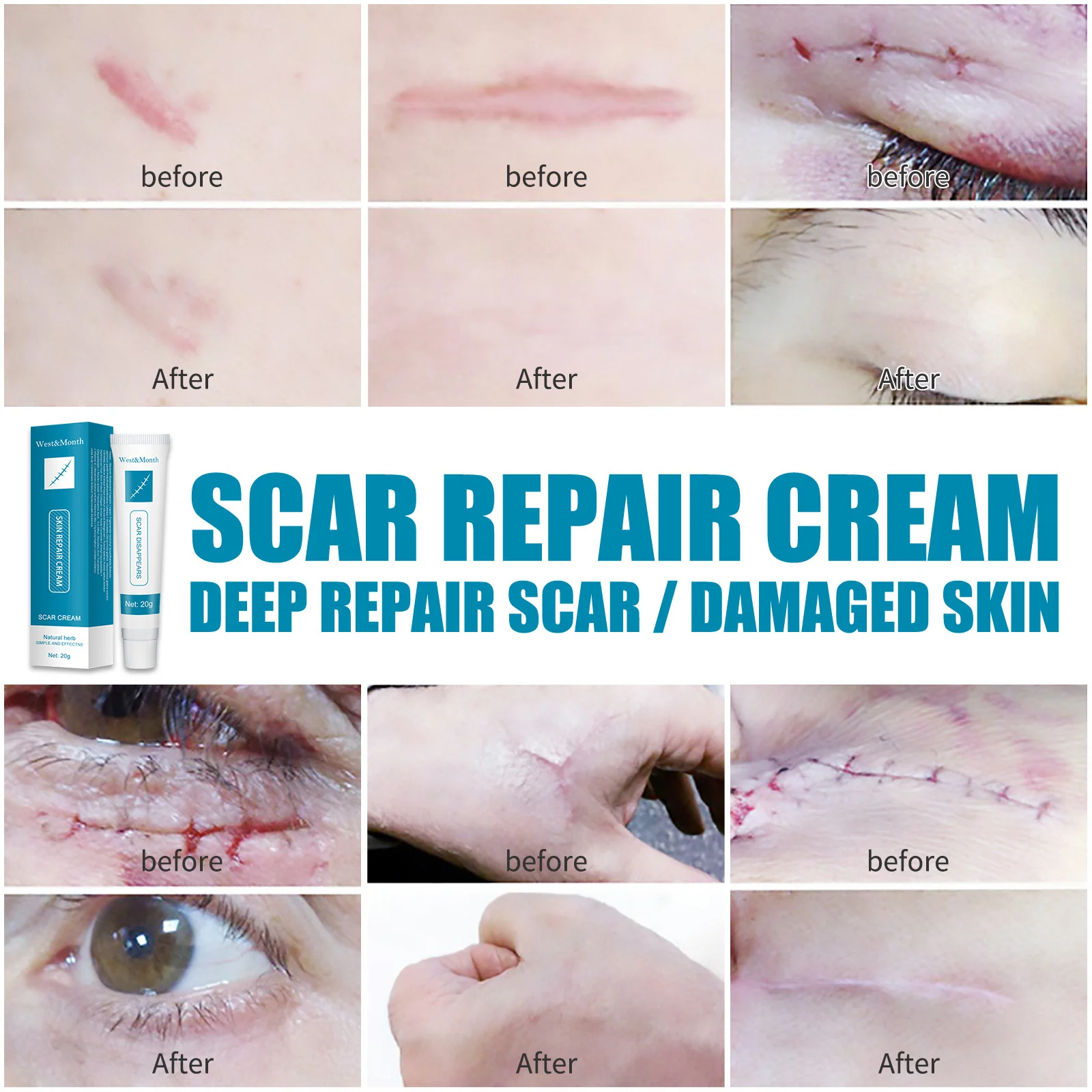 3pcs Scar Repair Cream Acne Remove Gel Fade Stretch Marks Acnes Spots Burn Surgical Scars Treatment Serum Smooth Body Skin Care