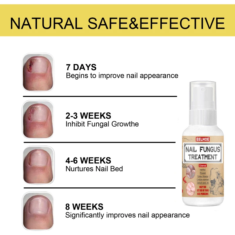 Фото 30ml Nail Fungal Treatment Spray Feet Repair Serum Nails Foot Toe Fungus Removal Gel Anti Infection Paronychia Onychomycosis №5