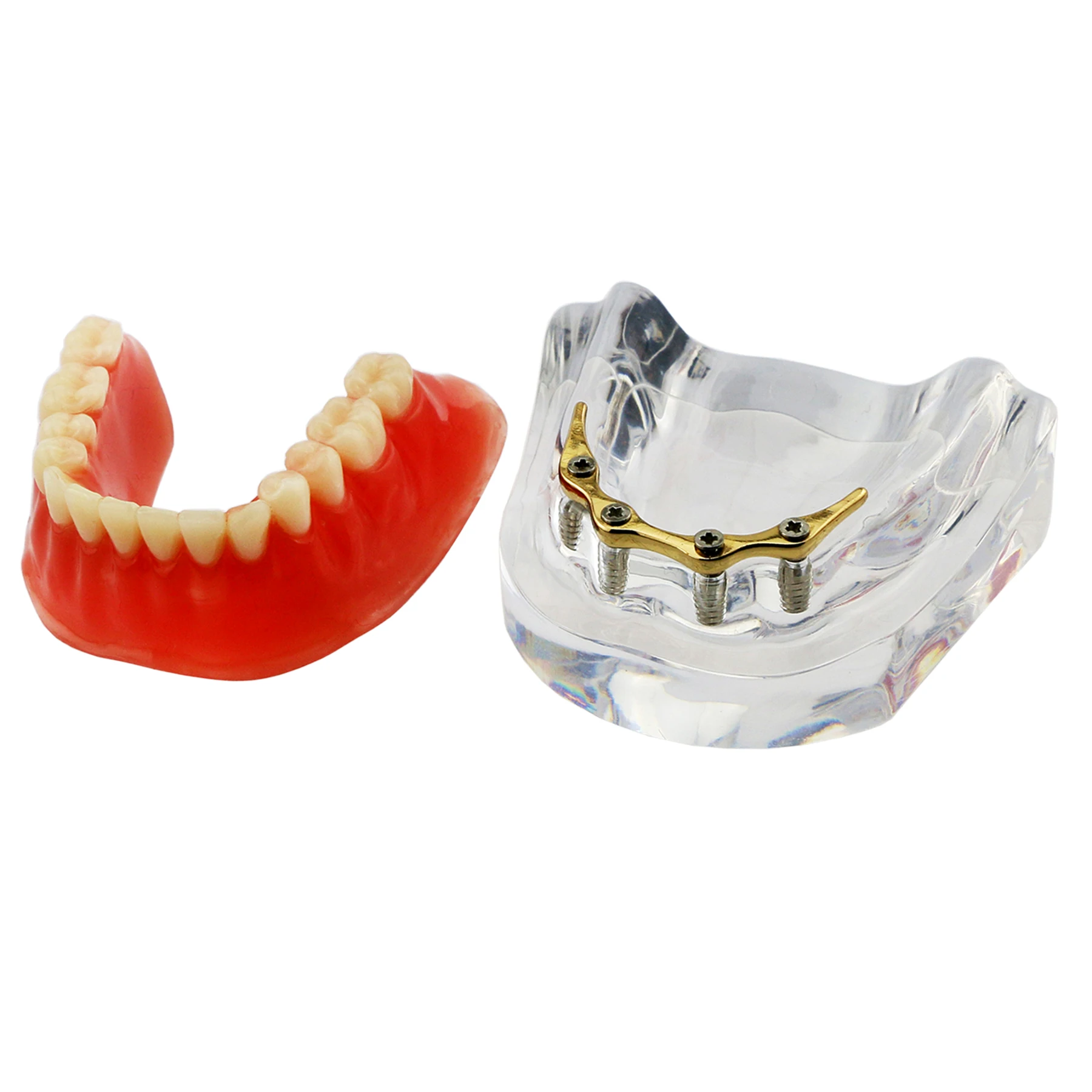 

BEST Dental Implant Teeth Model With Golden Bar Removable Overdenture 4 Implants Inferior Lower Restoration Treatment Demo Study