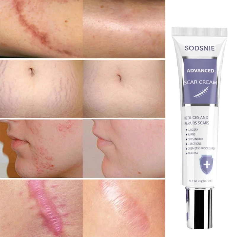 Scar Removal Cream Treatment Stretch Marks Burns Acne Spot Remover Surgery Scars Smoothing Skin Whitening Body Beauty Products