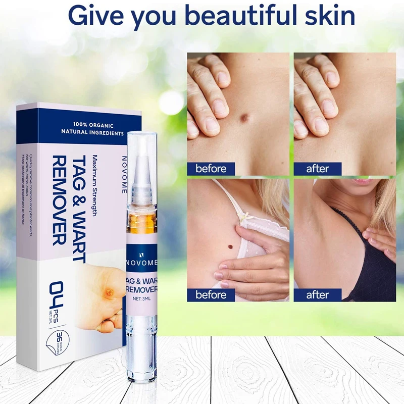 Средство для удаления бородавок с кожей 2022 |