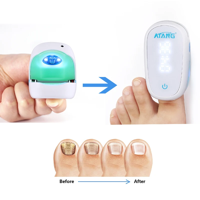 Painless Laser ATANG Onychomycosis Cleaning and Repairing Household Laser Portable Physiotherapy Instrument