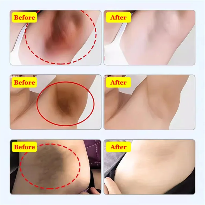 Отбеливающий крем для интимных частей подмышек отбеливание ягодиц коленей