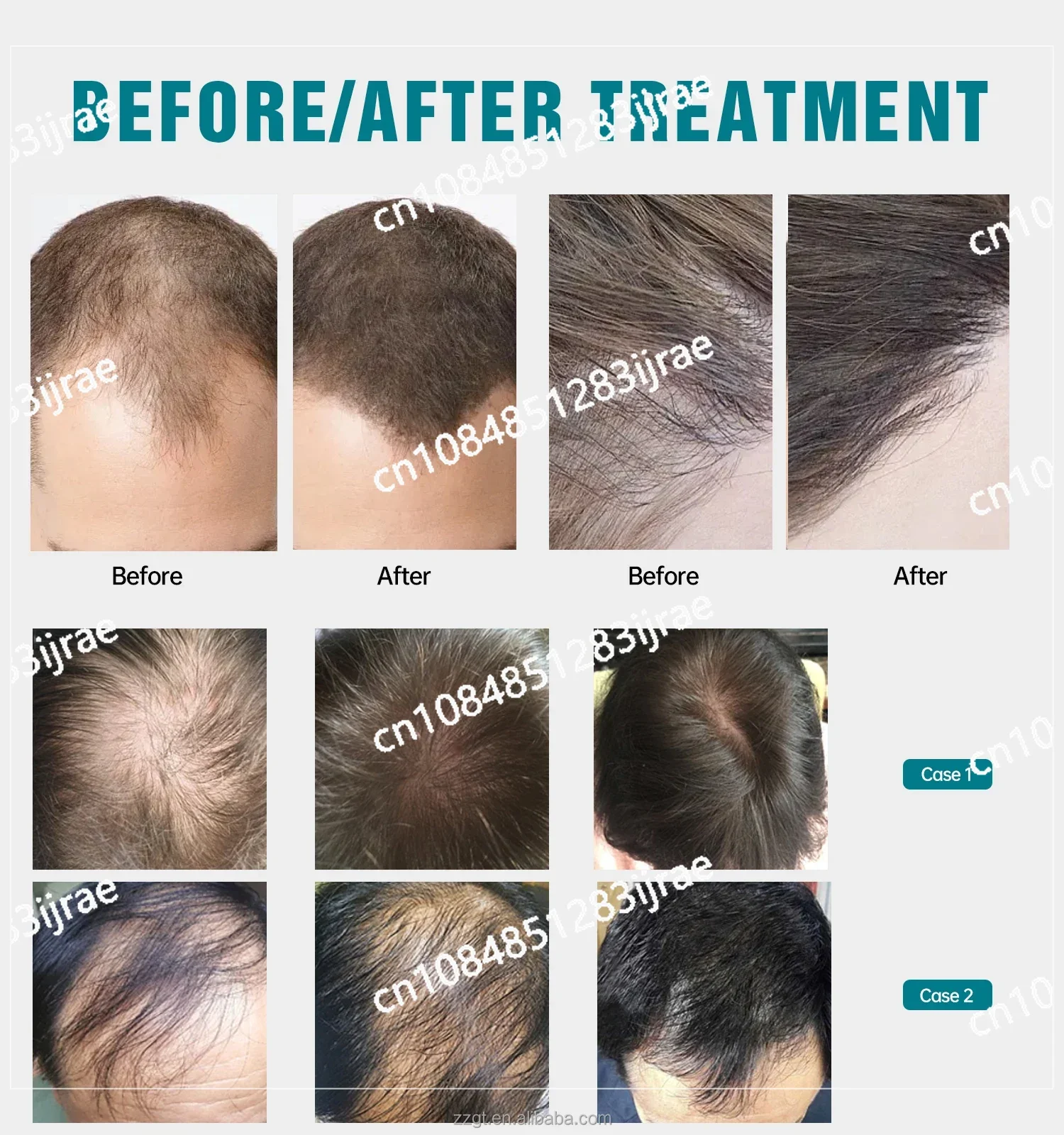 Выпадение волос светодиодная красная лампа 312 Диодная крышка Медицинское