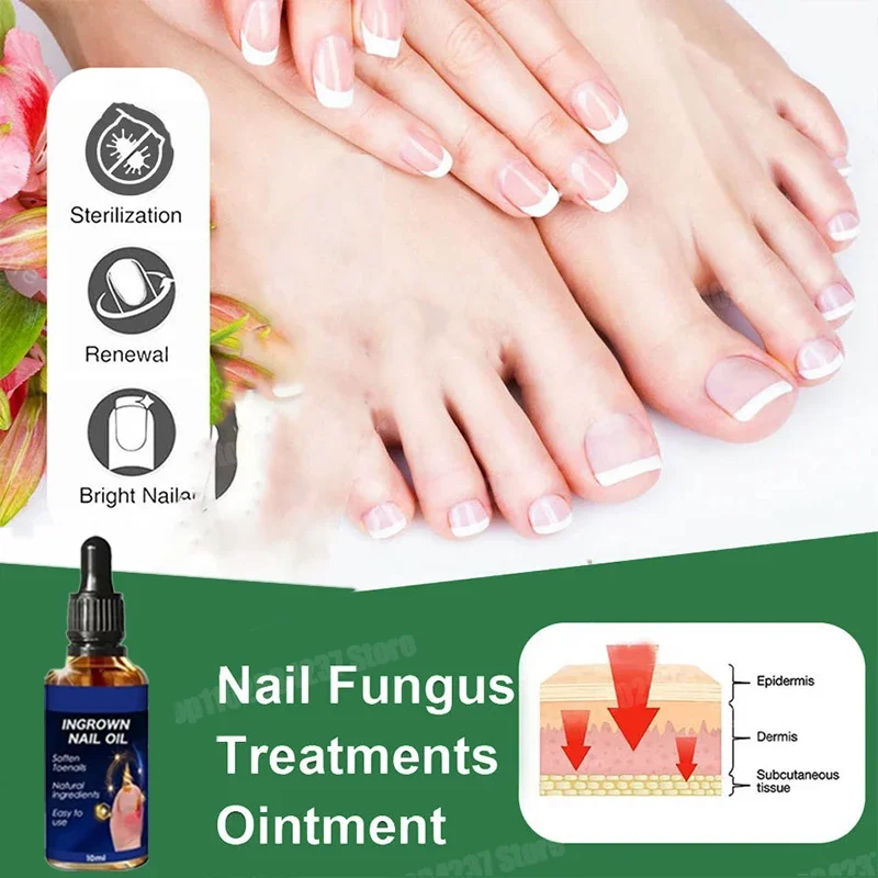 Крем для восстановления грибка ногтей мазь ухода противогрибковая