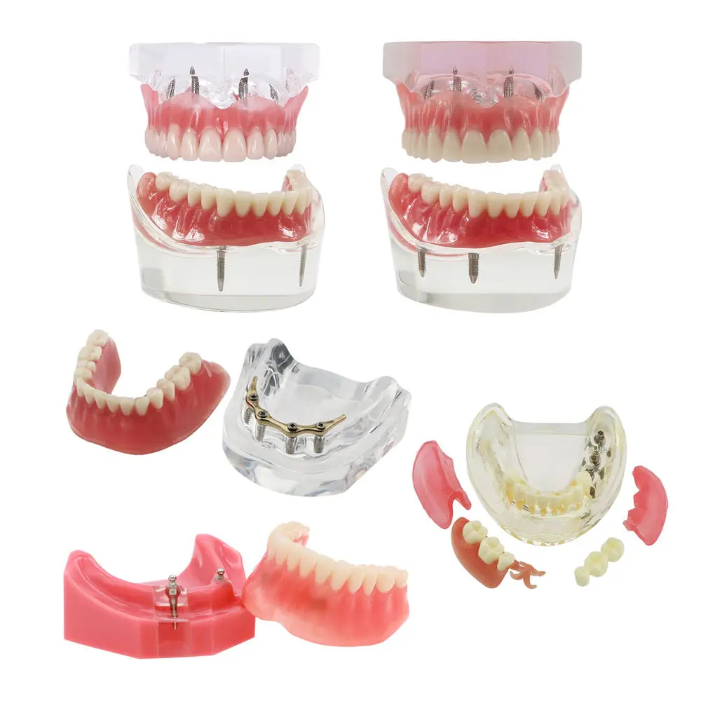 

Dental Implant Teeth Demo Model Overdenture Restoration with 2/4 Generic Implant