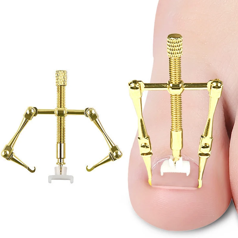 Набор медицинских корректирующих фиксаторов для вросших ногтей