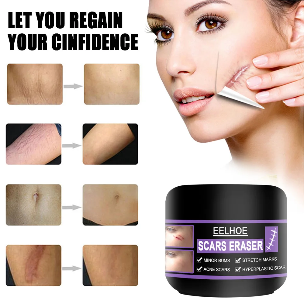 

Eelhoe Scar Repair Cream Acne Scar Removal Pigmentation Corrector Remove Stretch Marks Smooth Skin Whitening Scar Care 10-50g