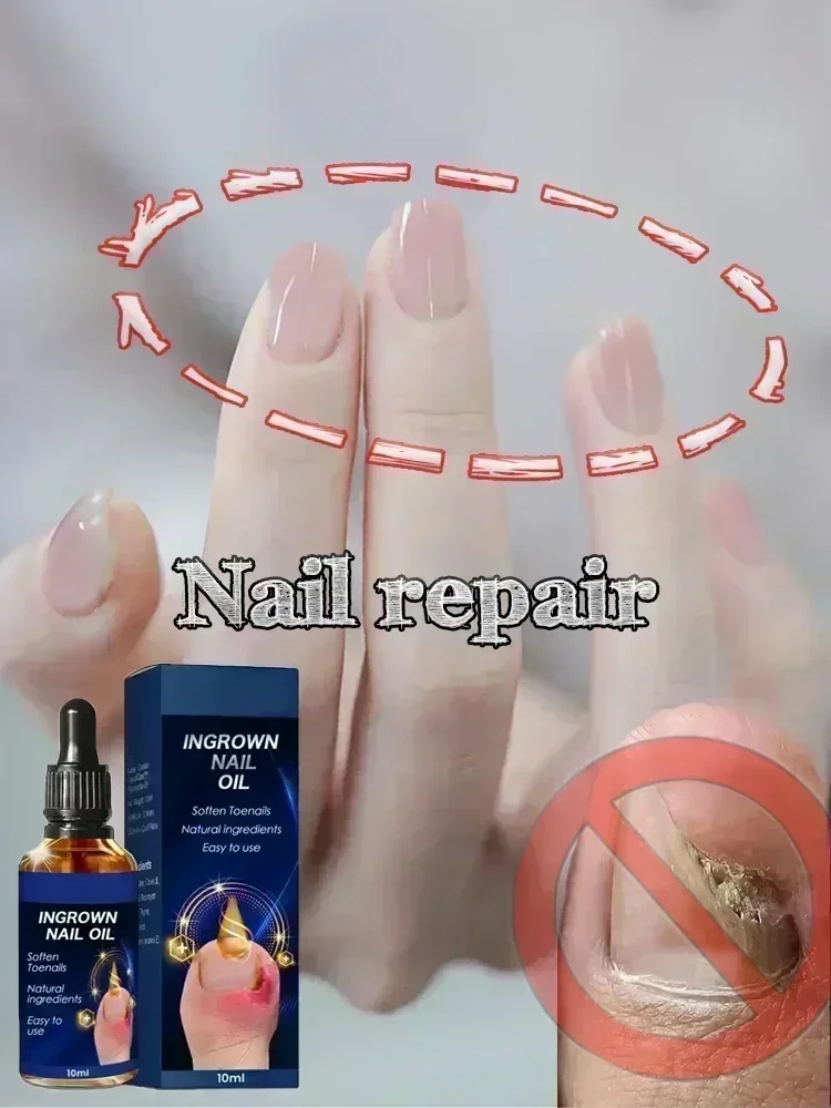 Крем для восстановления грибка ногтей мазь ухода противогрибковая