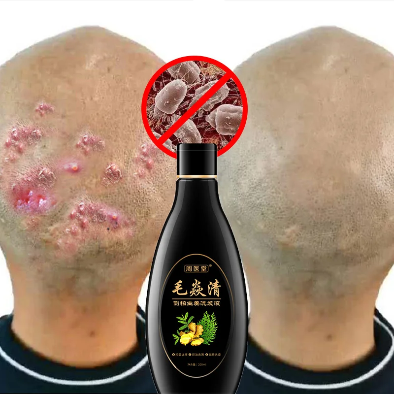 

Scalp Hair Follicle Shampoo Hair Care Product Antibacterial Anti-itching Mites Oil Control Psoriasis and Scalp Cleansing Shampoo