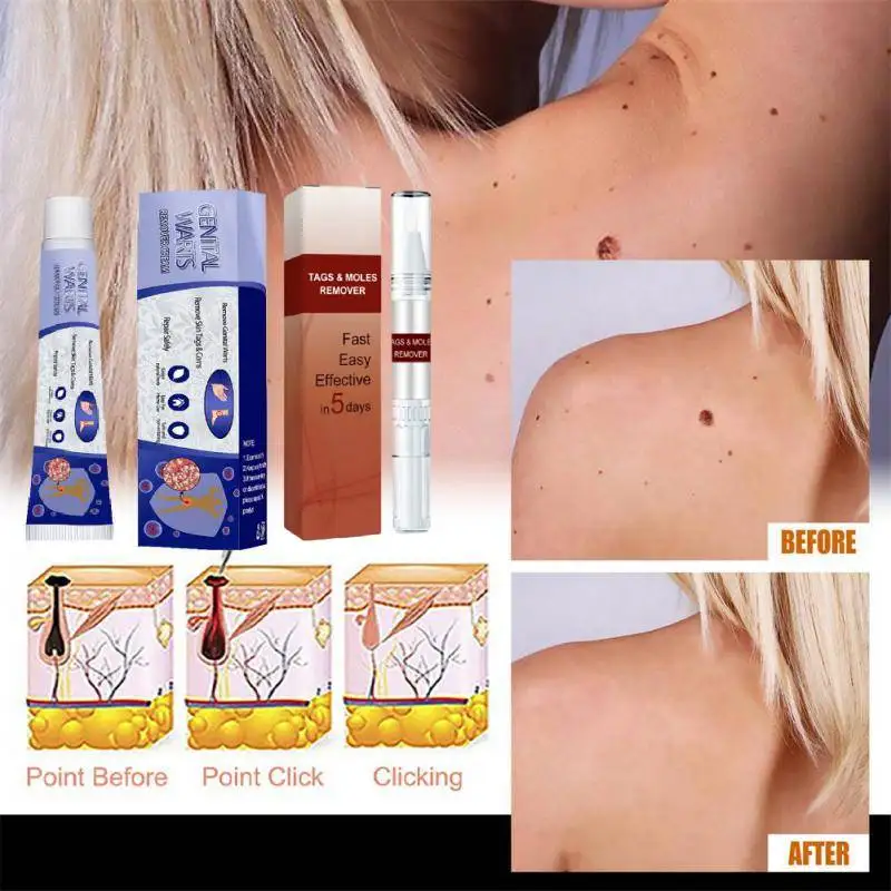 

20g Warts Remover Ointment Cream Skin Tags Removal Gel Face Body Care Mole Remover Body Warts Treatment Skin Tag Remover Ointmen