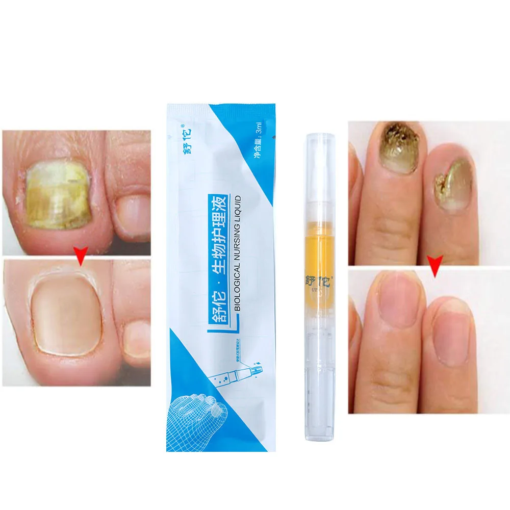 

Biological Care Solution to Nail Fungus Herbal Antibacterial Cleaning Solution Nail Care Solution