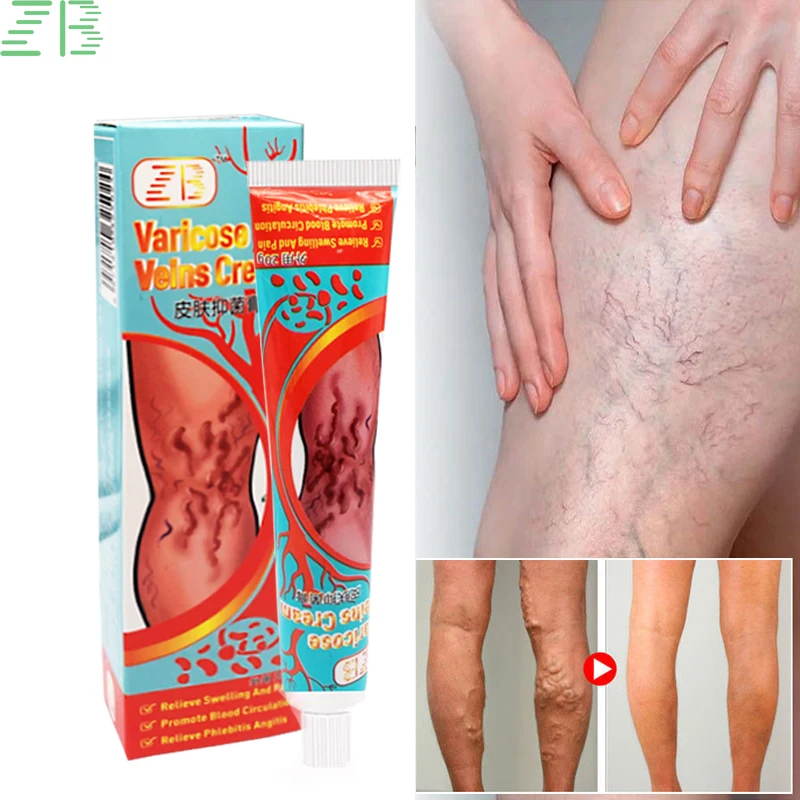 

Крем для лечения варикозного расширения вен, 20 г