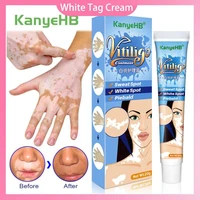 white spot skin cream vitiligo repair leukoplakia reduces white tag treatment pigment melanin promoting moisturizing liniment