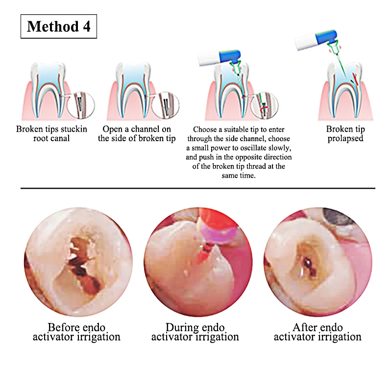 VVDental осциллятор корневого канала кариеса для полости рта гнездо очистки