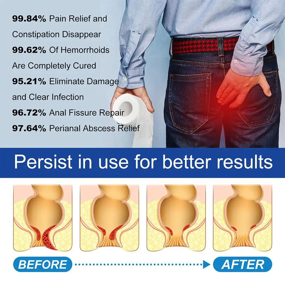 Натуральные травы капсулы от геморроя для внутренних сваи уход за внешней