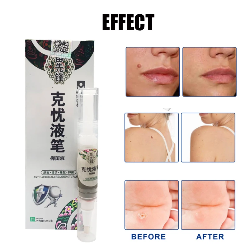 

5ml Warts Flat Dressing Papilloma Of Wart Removal Warts Mole Skin Treatment Pen Warts Skin Repair Without Trace Beauty Liquid
