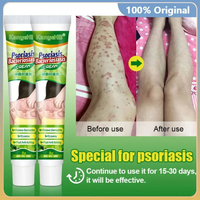 

1~10PCS 2022 New Psoriasis Cream Eczema Ointment Scalp Psoriasis Hand Tinea Foot Odor Tinea Versicolor Inhibit Fungus Anti-itch