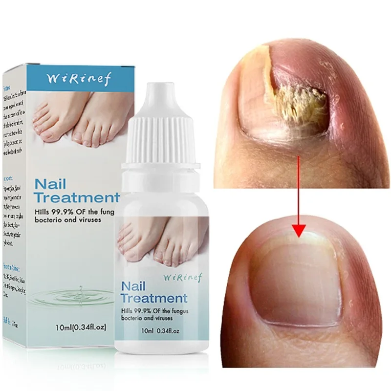 Nail Fungal Treatment Essence Onychomycosis Toe Nails Fungal Removal Gel Anti-Infection Onychomycosis Foot Care Serum Skin Care