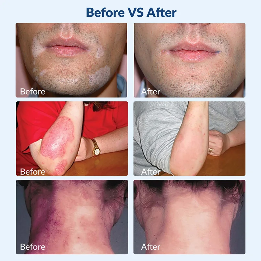 ZJKC 308nm Экксимерная система Фотодинамическая терапия УФ-световое устройство для