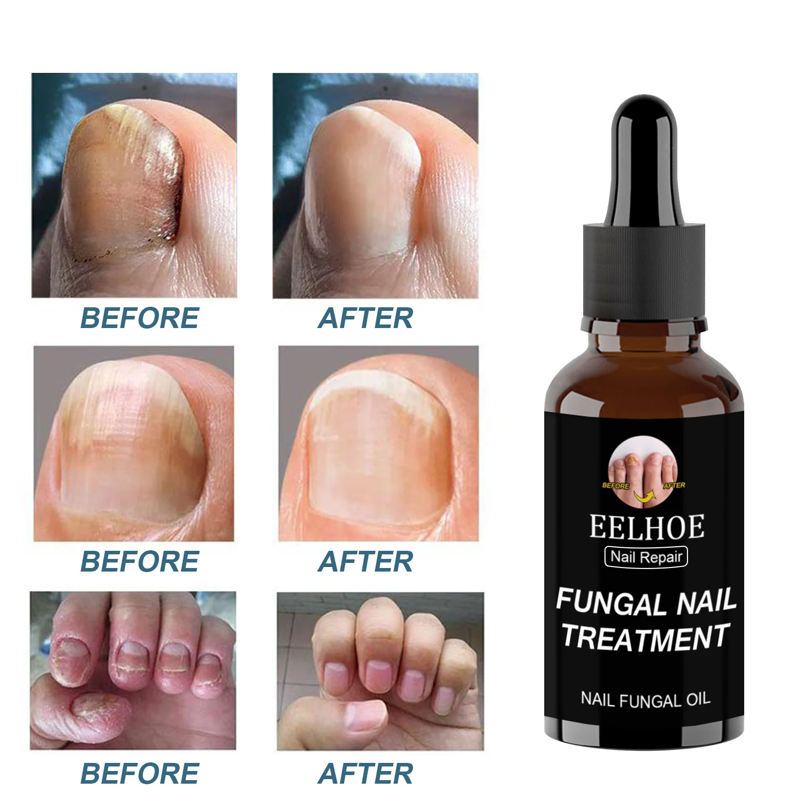 

Fungal Nail Repair Essence Feet CareTreatment Foot Toe Nail Fungus Removal Gel Anti Infection Paronychia Onychomycosis Care 30ml