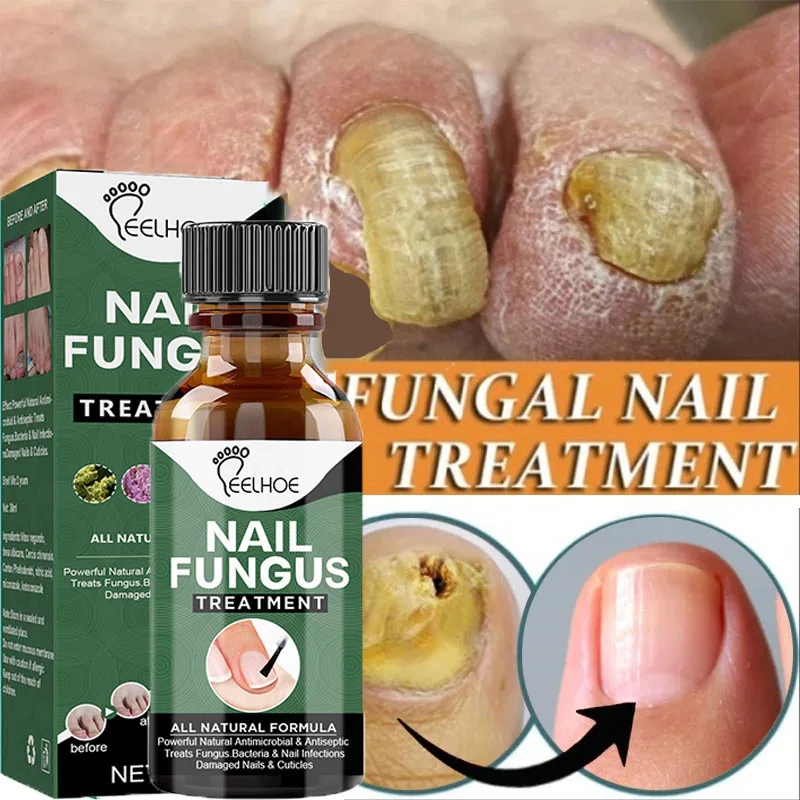 

Nail Fungus Treatments Remove Grey Nail Concave Convex Thick Nail Thickening Soft Nail Hand Foot Repair Liquid Anti-Infection
