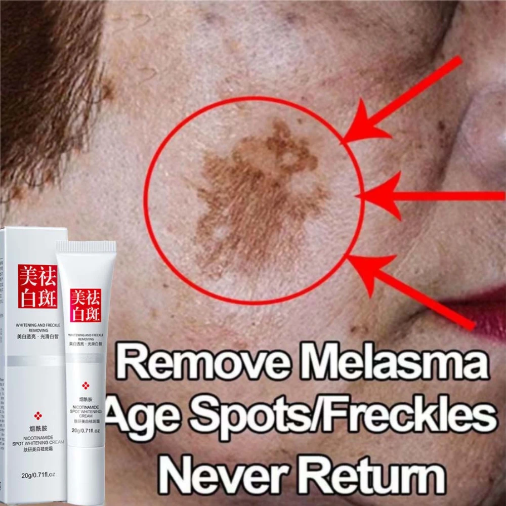 

Effective Whiten Freckle Cream Remove Dark Spot Melasma Fade Melanin Anti-Pigmentation Improve Dullness Brighten Face Skin Care