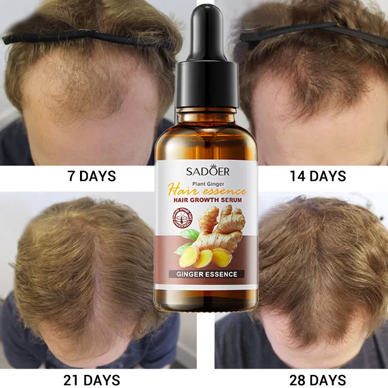 

Hair Growth Products Ginger Fast Growing Hair Essential Oil Beauty Hair Care Prevent Hair Loss Oily Scalp Treatment Men Women