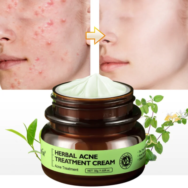 

Anti-acne Whitening Freckle Repair Oil Control Facial Skin Care Herbal Acne Cream 30g Acne and Spot Cream Aloe Vera Gel