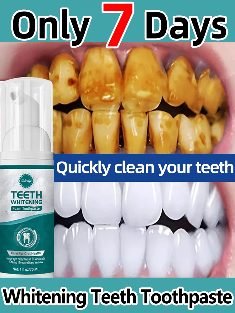 Отбеливание зубов Удаление зубного камня