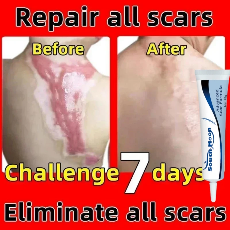 Крем для удаления шрамов со старыми шрамами новинка шрамы хирургические